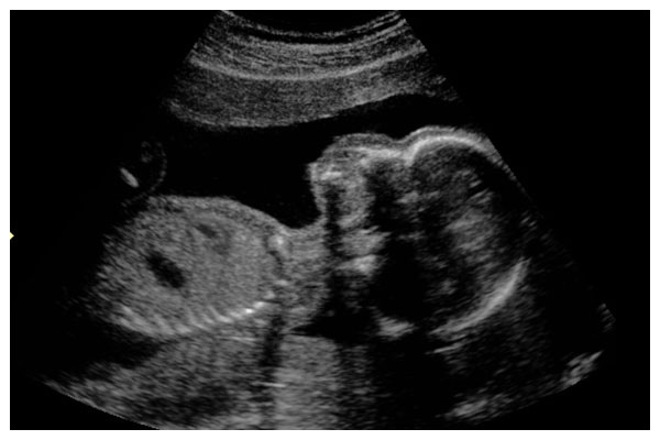 2D Gender Ultrasound